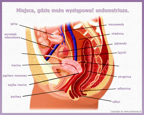 występowanie endometriozy, jak rozpoznać endometriozę